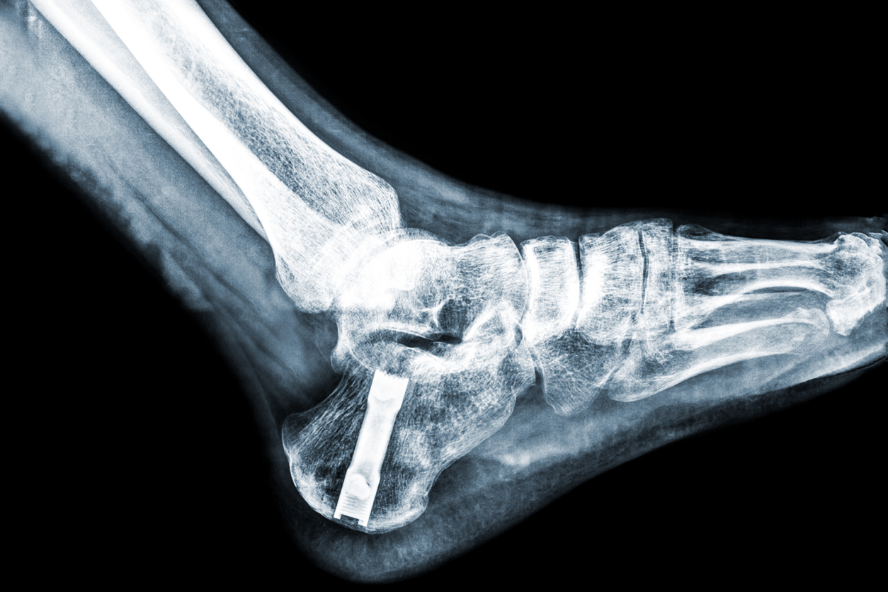 total ankle