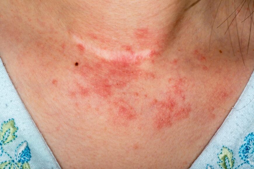 Avoiding Irritants
