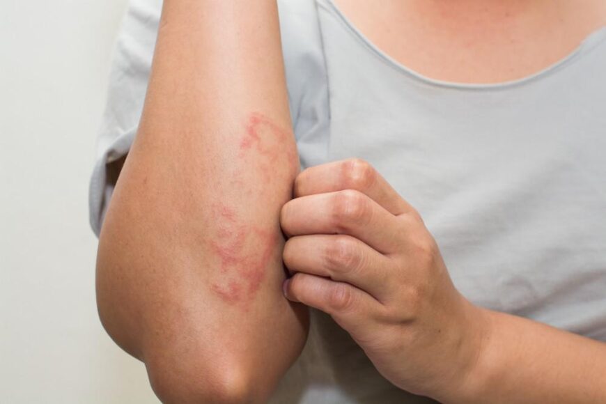 Managing Itching and Scratching