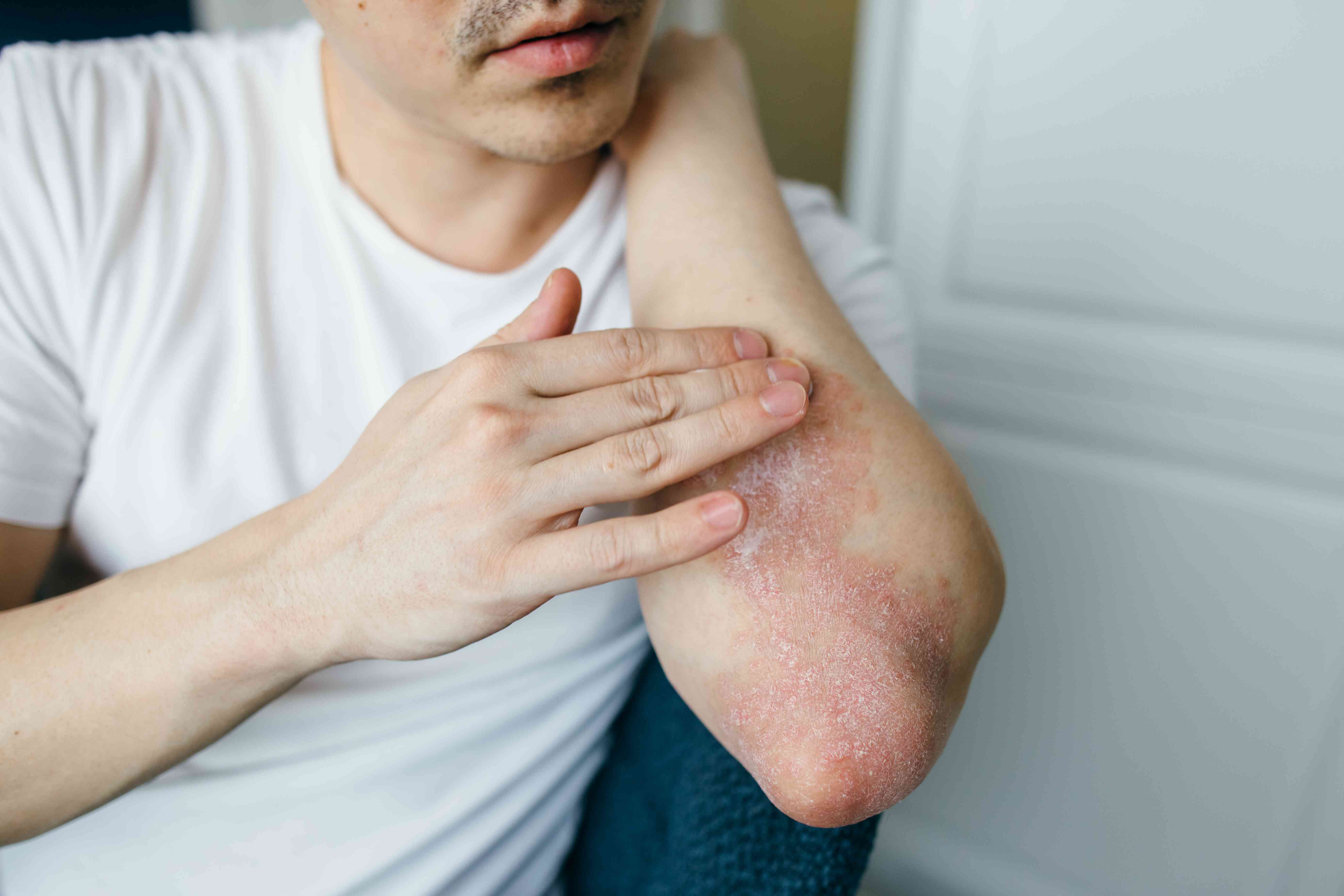 Rapidly Soothing an Eczema Flare