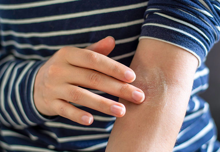 eczema Moisturizing