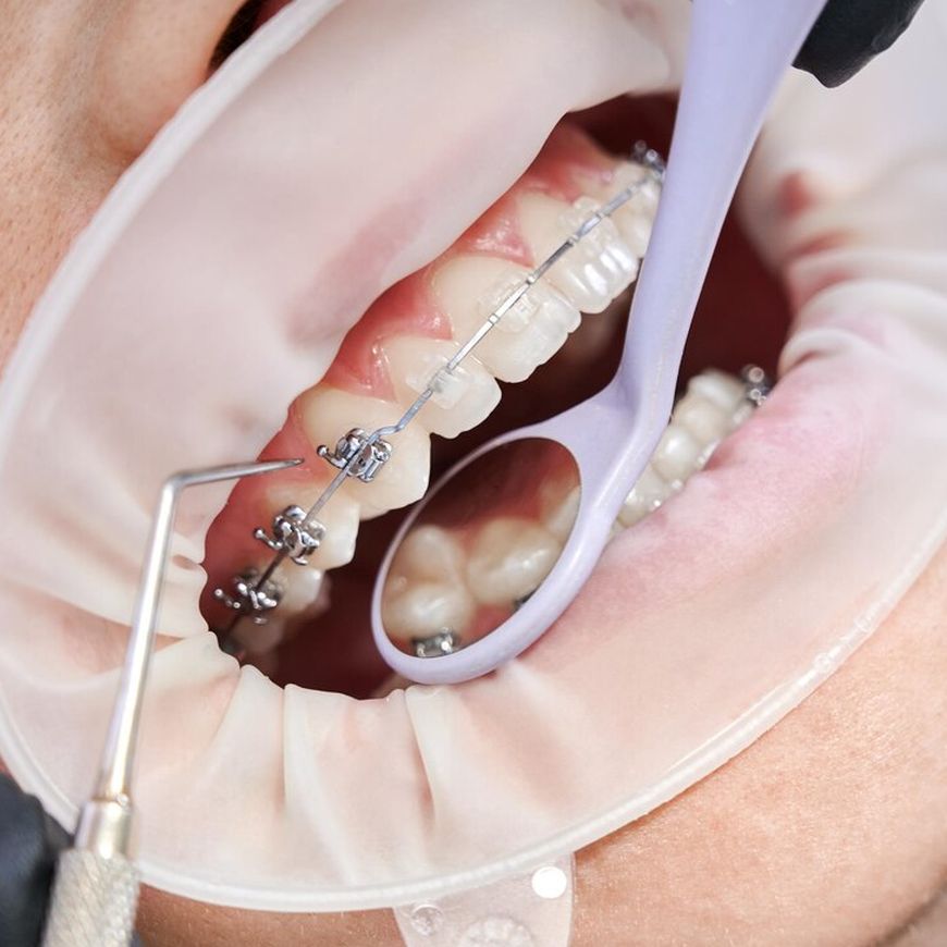 What Are Clear Bracket Braces
